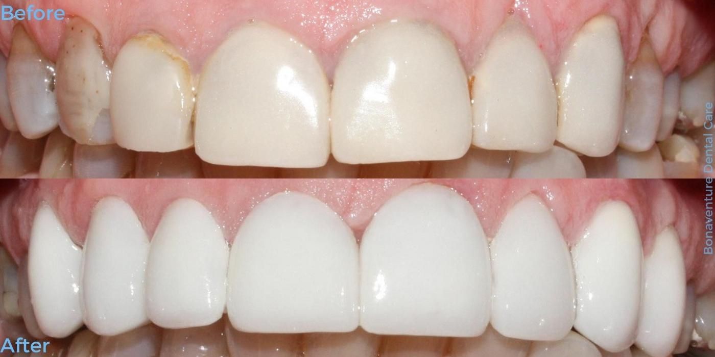 Before and after treatment at Bonaventure Dental Care