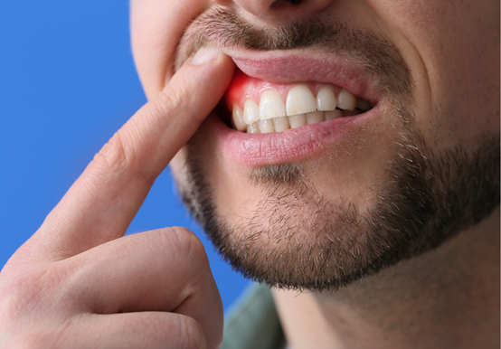 ALL ABOUT GUM DISEASE