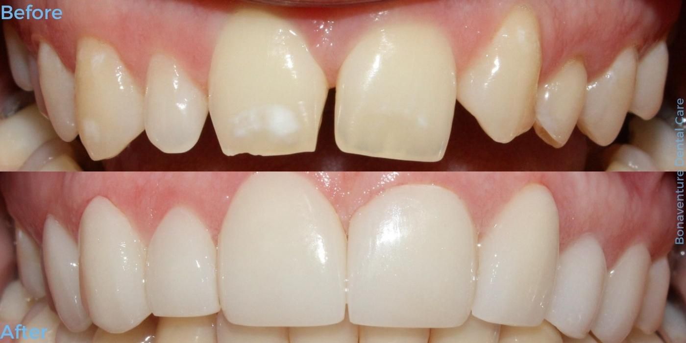 Before and after treatment at Bonaventure Dental Care