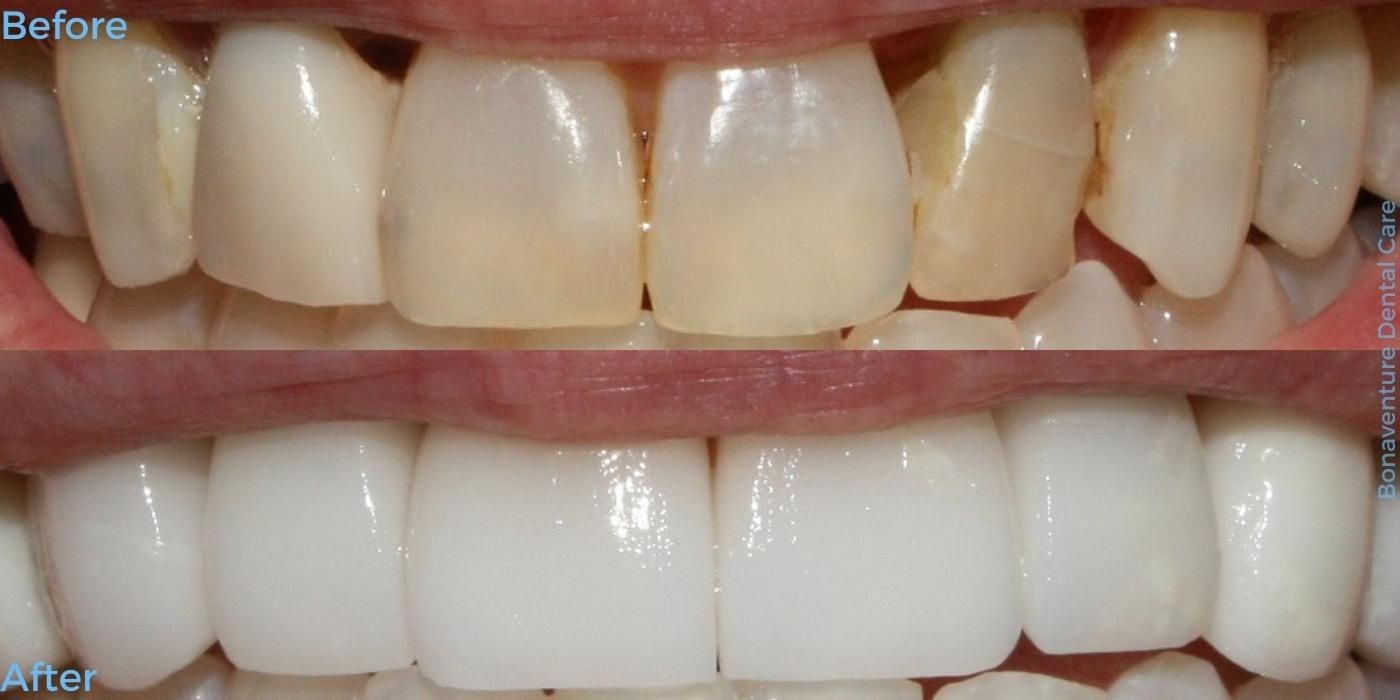 Before and after treatment at Bonaventure Dental Care