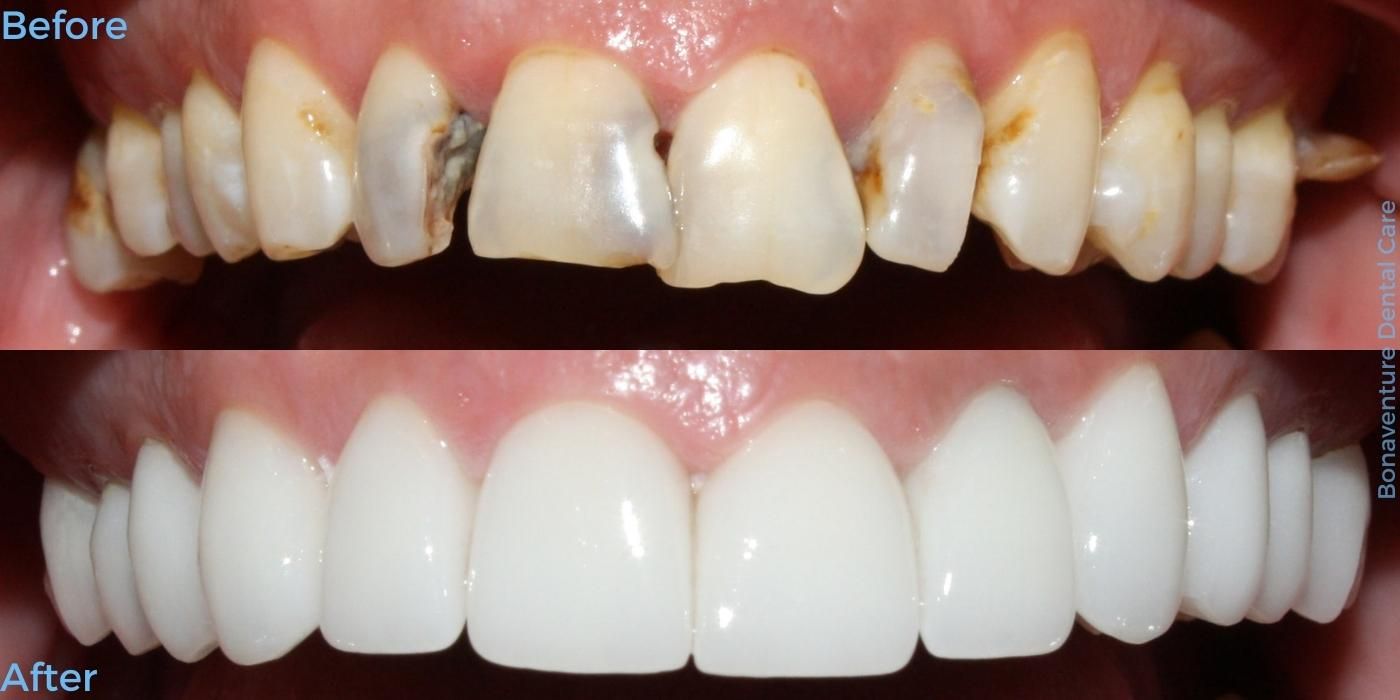 Before and after treatment at Bonaventure Dental Care