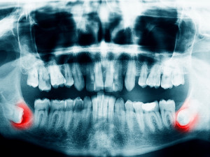 Dentist in Baton Rouge Benefits of Removing Wisdom Teeth. Don’t let it Impact Your Life