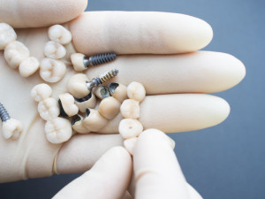 Dentist in Baton Rouge Crown Your Teeth to Shine like Royalty with Dental Crowns