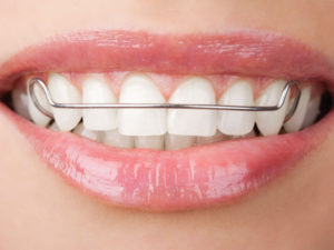 Dentist in Baton Rouge When You Can Stop Wearing Your Retainer
