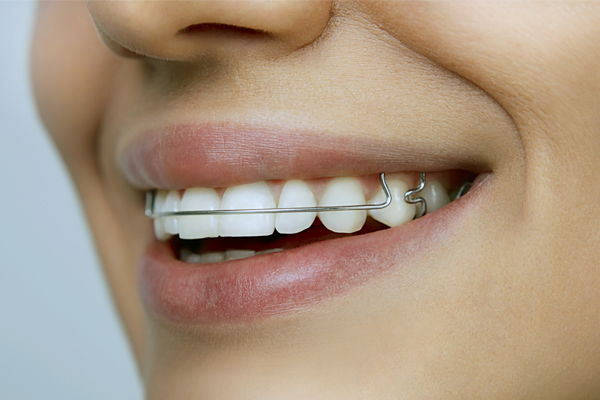 Dentist in Baton Rouge How to Properly Care for A Retainer