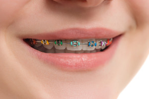 Dentist in Baton Rouge The Costs of Not Wearing Your Retainer