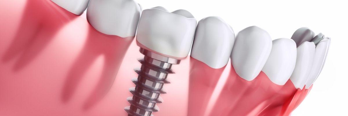 A quick guide to dental implants
